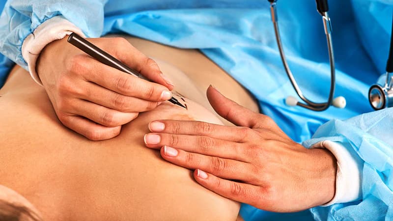 Brustvergrößerung mit Eigenfett: So wirkt der natürliche Volumenaufbau